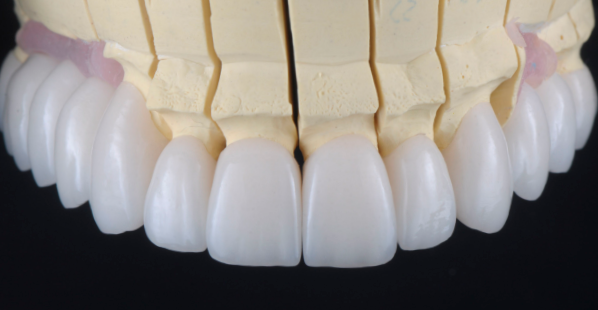 Reabilitações Cerâmicas-Das Lentes de Contato Dental às Reabilitações com alteração da D.V.O.